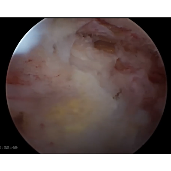 UBE Thoracic Floodwood Technique for Thoracic Ossification of Ligamentum Flavum (OLF)